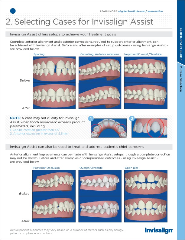 New Invisalign Quick Start Guide for Cosmetic Dental Braces
